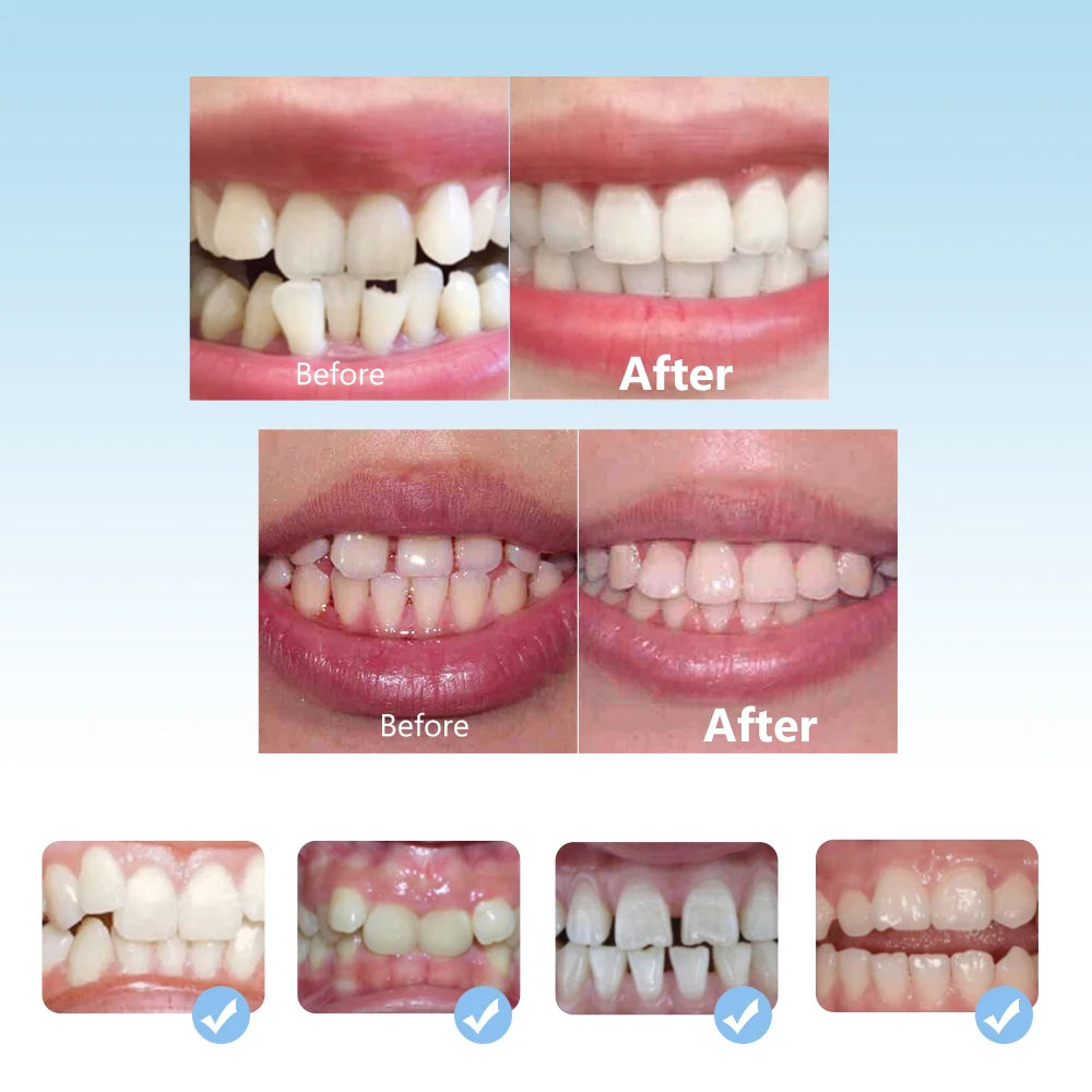 3 Stage Kids Silicone Dental Alignment Trainer Retainer Set - 12