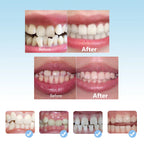 3 Stage Kids Silicone Dental Alignment Trainer Retainer Set