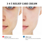 345 Relief Facial Moisturizing Cream for Blemish and Acne Care