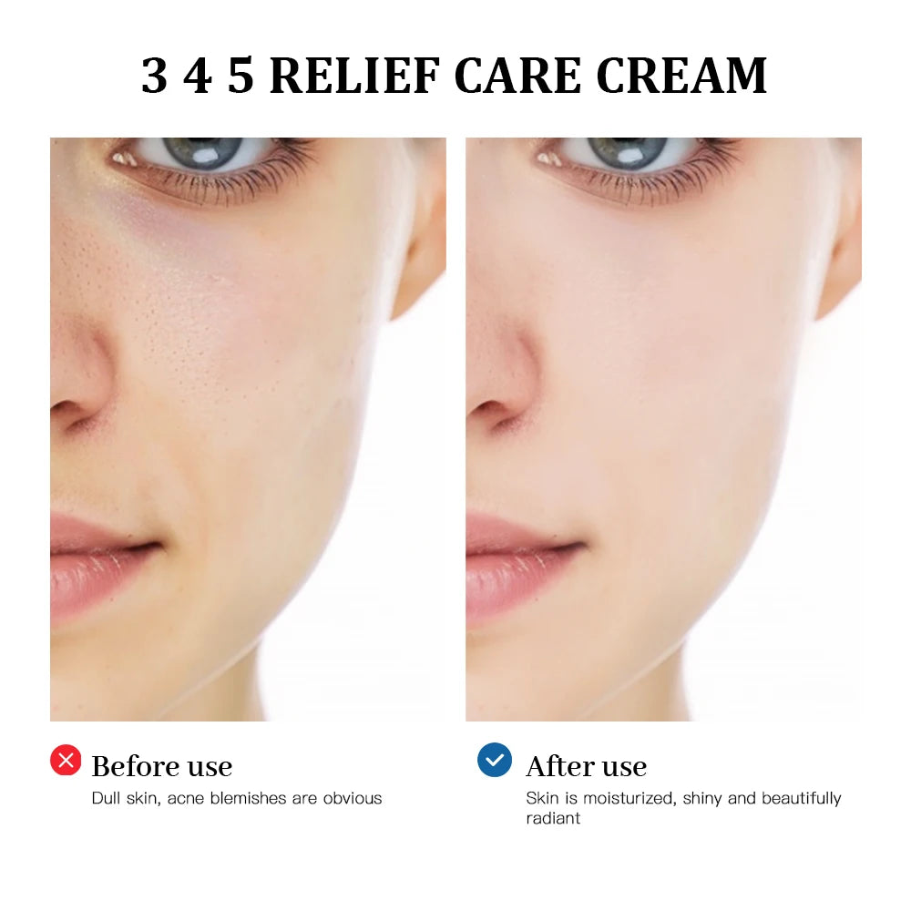 345 Relief Facial Moisturizing Cream for Blemish and Acne Care