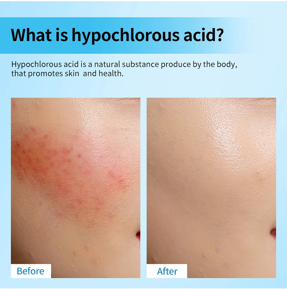 Hypochlorous Acid Facial Spray Skin Toner